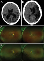 Thumbnail of Representative nonenhanced computed tomography (CT) brain scans and composite scanning laser ophthalmoscope fundus images of 2 Ebola virus disease survivors attending a joint neurologic and psychiatric clinic in Sierre Leone. A) Patient no. 37, female, age 12. CT of brain shows disproportionate parietal and temporal lobe atrophy. B) Patient no. 25, male, age 42. CT of brain shows extensive gliosis within the left middle cerebral artery territory reflects an old infarct with ex-vacuo
