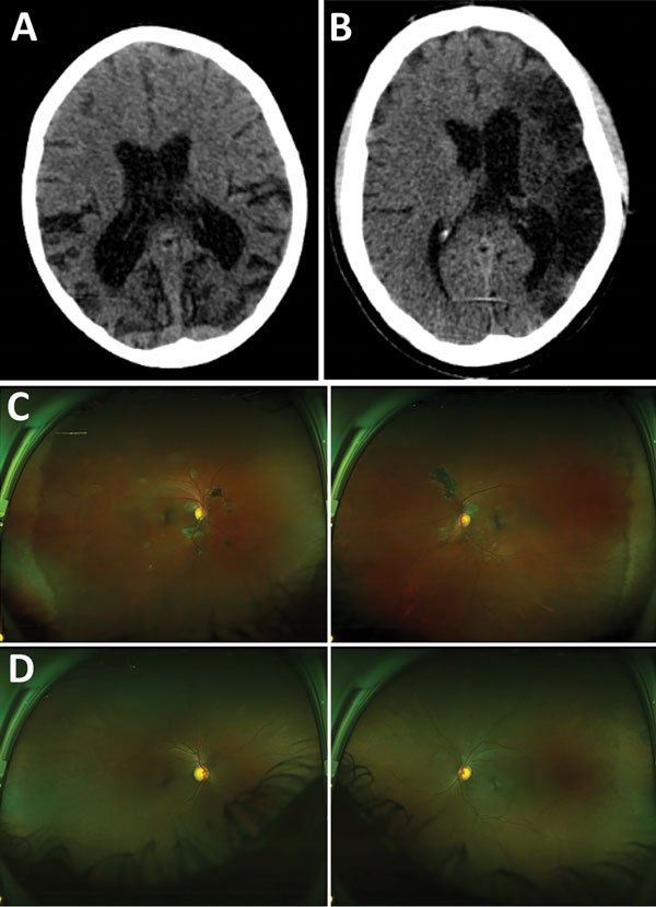 Representative nonenhanced computed tomography (CT) brain scans and composite scanning laser ophthalmoscope fundus images of 2 Ebola virus disease survivors attending a joint neurologic and psychiatric clinic in Sierre Leone. A) Patient no. 37, female, age 12. CT of brain shows disproportionate parietal and temporal lobe atrophy. B) Patient no. 25, male, age 42. CT of brain shows extensive gliosis within the left middle cerebral artery territory reflects an old infarct with ex-vacuo dilatation o