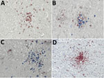Thumbnail of Immunohistochemical analyses of nodule cell compositions from typhus patients during World War II, Hamburg, Germany, 1940–1944. Tissue sections were incubated with specific antibodies and visualized with immunoperoxidase (brown) or immunophosphatase (blue) stains and lightly counterstained with hematoxylin. A) CD3 stain (brown) for T cells and CD20 stain (blue) for B cells. Only T cells are visible within the nodule. Original magnification ×40. B, C) CD4 stain (brown) and CD8 stain 