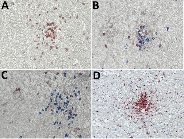 Immunohistochemical analyses of nodule cell compositions from typhus patients during World War II, Hamburg, Germany, 1940–1944. Tissue sections were incubated with specific antibodies and visualized with immunoperoxidase (brown) or immunophosphatase (blue) stains and lightly counterstained with hematoxylin. A) CD3 stain (brown) for T cells and CD20 stain (blue) for B cells. Only T cells are visible within the nodule. Original magnification ×40. B, C) CD4 stain (brown) and CD8 stain (blue) for T 