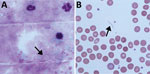 Thumbnail of Microscopy of blood from a patient with recurrent fever episodes after traveling to southern Africa, 2015. Arrows indicate spirochetes. 100× magnification. A) Thick smear specimen; B) thin smear specimen. 