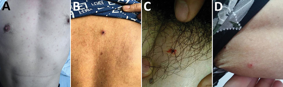 Lesions on patients with Rickettsia japonica infection, Xinyang, China, March 2014–June 2017. A) Rash on ventrum; B) rash and eschar on back; C) eschar on femoribus internus; D) tick bite site on left armpit.
