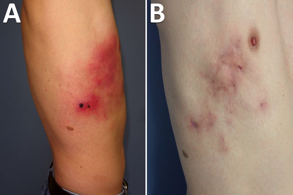 Cowpox virus infection in smallpox-vaccinated patient in France, 2016. A) Profile appearance of the patient’s torso 1 month after the initial trauma. B) Appearance 9 months after the initial trauma.