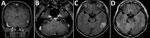 Thumbnail of Brain magnetic resonance imaging findings in a 36-year-old immunocompetent man before (A, B, C) and after (D) treatment for cerebral syphilitic gumma, Saitama, Japan. A) Gadolinium-enhancement T1-weighted coronal images show an enhanced nodular lesion in the left temporal lobe. B) Coronal gadolinium-enhanced T1-weighted images show enhancement within the cisternal segment of both the vestibulocochlear nerve complex and the facial nerve. C) Axial fluid-attenuated inversion recovery i