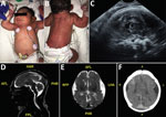 Thumbnail of Term male infant (case-patient 1) with presumed congenital Zika syndrome, Brownsville, Texas, USA, 2016–2017. A) Microcephaly on the day of birth. Head circumference was 29 cm, which is 2.63 SDs below the mean value for term male newborns. Craniofacial abnormalities present are mild narrow and laterally depressed frontal bone and mild retrognathia. B) Generalized pustular melanosis rash. C) Prenatal transvaginal ultrasonographic (midsagittal plane) image at 37.2 weeks’ gestation, sh