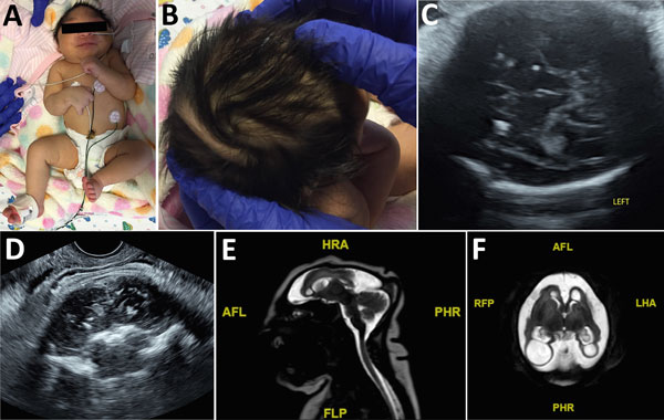Term female infant (case-patient 2) with presumed congenital Zika syndrome, Brownsville, Texas, USA, 2016–2017. A) Microcephaly on the day of birth. Head circumference was 26.5 cm, which is 6.23 SDs below the mean value for term females. Craniofacial disproportion with narrow and laterally depressed frontal bone are seen. Upper wrist contractures are present, more apparent on the right, with ulnar deviation. B) Redundant scalp skin with multiple rugae. C) Transabdominal ultrasonography image of 