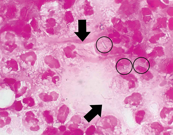 Gram staining of pus obtained from a patient with rat-bite fever. Circles indicate pyrophosphate calcium crystals. Arrows indicate chain-shaped gram-negative bacilli. Original magnification ×1,000.