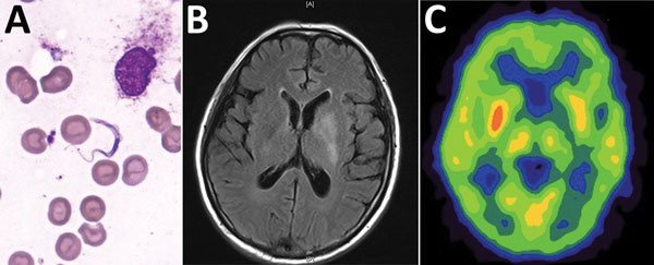 Bone marrow test results and brain imaging of a 60-year-old man who returned to China from Gabon with suspected human African trypanosomiasis. A) Trypanosoma spp. (later determined to be T, brucei gambie) in a Giemsa-stained thin bone marrow film. Original magnification ×1,000. B) A T2-weighted FLAIR image with hyperintense signal changes in the left basal ganglia. C) Brain positron emission tomography–computed tomography suggested reduced glucose metabolism in the left basal ganglia.