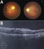 Thumbnail of Ocular examination conducted 2 months after eye surgery in patient with human endophthalmitis caused by pseudorabies virus, China, 2017. A) Fundus photography of both eyes showing retinal necrosis and occlusive vasculitis and postoperative change after pars plana vitrectomy with silicone oil injection in the right eye. B) Optical coherence tomography of the patient’s right eye showed postoperative change after pars plana vitrectomy. 2, scan depth (2 mm); I, inferior, L, left eye; N,