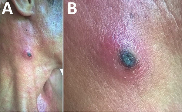 Eschar on right anterior neck of patient with dual genotype Orientia tsutsugamushi infection, Vietnam. A) Eschar location; B) enlarged view.