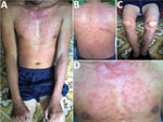 Thumbnail of Rash on patient with dual genotype Orientia tsutsugamushi infection, Vietnam. A) Trunk and arms; B) back; C) legs; D) chest.