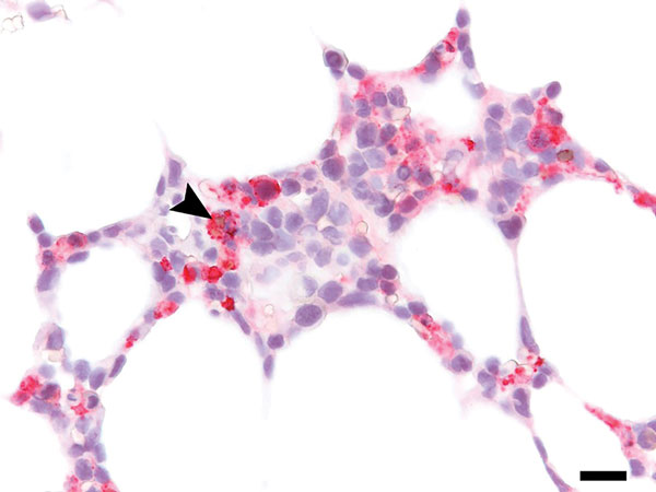 Immunohistochemistry of bone marrow from immunocompromised patient infected with Heartland virus (HRTV), Missouri, USA. Testing of biopsied sample from post–symptom onset day 11 shows extensive positive staining for HRTV antigen, including erythrophagocytosis by an HRTV-antigen–positive cell (arrowhead). Original magnification ×400.