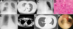 Thumbnail of Radiological imaging, sputum smear finding, and endobronchial image of 2 case-patients with severe pneumonia caused by Corynebacterium ulcerans infection, Japan. Case-patient 1: A) Atelectasis in middle lung field at admission; B) consolidation and atelectasis in right upper lobe; C) rapid development of diffuse atelectasis; D) gram-positive rods in all fields of endotracheal aspiration sputum sample (original magnification x1,000). Case-patient 2: E) Infiltrates in left lower lung 