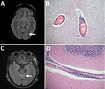 Thumbnail of Pathologic and virologic findings for 2 patients with tick-borne encephalitis, Finland, 2015. A) Magnetic resonance images of 36-year-old woman (patient 1) with pathologically increased signal in cortical sulcus regions indicative of viral meningeal process (arrow). B) Hematoxylin and eosin staining of the frontal cortex of patient 1 showed inflammation throughout the central nervous system from the spinal cord to the cortex and cerebellum; original magnification ×100. C) Magnetic r