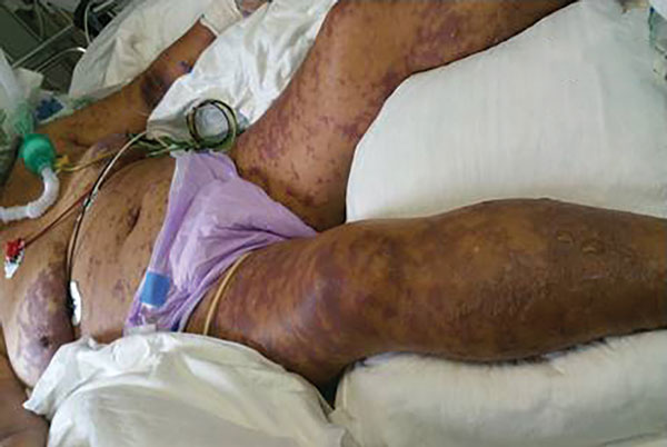 Case-patient 1, a 75-year-old woman with Israeli spotted fever and purpura fulminans, Sharon District, Israel, 3 days after hospitalization. Diffuse fern-leaf pattern of purpura and newly formed bulla on the legs are shown.
