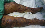 Thumbnail of Case-patient 1, a 75-year-old woman with Israeli spotted fever and purpura fulminans, Sharon District, Israel, 7 days after hospitalization. A rash on the legs that had become bullous and contained clear serous fluid is shown.