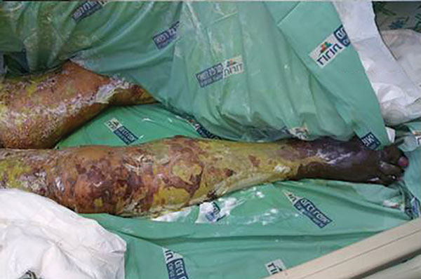 Case-patient 1, a 75-year-old woman with Israeli spotted fever and purpura fulminans, Sharon District, Israel, 14 days after hospitalization. Dusky skin lesions on the legs, necrosis at the extremities, and extensive desquamation are shown.