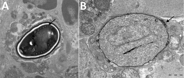 Transmission electron micrographs of vastus lateralis muscle from a 66 year-old man with Anncaliia algerae microsporidial myositis, New South Wales, Australia. A) Mature spore with 11 polar tubule coils (arrow) in a single row. Dense exospore and pale endospore. B) Binucleate, proliferative phase meront with characteristic vesicotubular appendages (arrow). Scale bars = 500 nm.