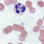 Thumbnail of Anaplasma phagocytophilum morulae observed on peripheral blood smear from patient in whom anaplasmosis infection developed after a blood transfusion, New York, New York, USA. Intracytoplasmic inclusions (morulae) were first seen 15 days after the patient was transfused with an infected erythrocyte unit, leading to a diagnosis of human granulocytic anaplasmosis later confirmed by PCR (original magnification ×1,000 [oil immersion]).