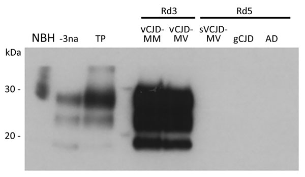Western blot analysis of vCJD prions obtained after amplification by protein misfolding cyclic amplification (PMCA) of cerebrospinal fluid (CSF) from 2 patients with vCJD (MM and MV) and 3 control patients and a crude reference brain homogenate from a vCJD patient (National Institute for Biological Standards and Control [Ridge, UK] no. NHBY0/0003). Abnormal prion protein patterns were assessed by using antibody 3F4 after digestion of samples with proteinase K. A total of 20 μL of each sample was