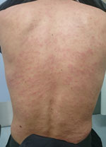 Thumbnail of Rash on the back of a patient (patient 10 in Table 1) with confirmed Trichinella T9 infection associated with consumption of bear meat, Japan, December 2016. Patient had onset of macular and popular, confluent, and pruritic rash with diffuse blanching on the scalp, face, chest, abdomen, back, and upper and lower extremities. Photo taken 24 days after the patient had consumed the implicated bear meat.