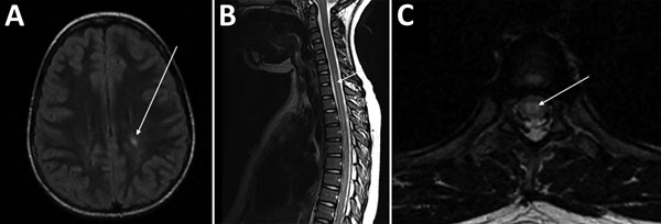 Magnetic resonance images (MRIs) on day 10 of illness in a 10-year-old girl with transverse myelitis and Guillain-Barré syndrome associated with cat-scratch disease, Houston, Texas, USA, 2011. A) Brain MRI. Arrow indicates focus of increased T2 signal in the left posterior periventricular and deep white matter. B) Sagittal spine MRI. Arrow indicates long segment of increased T2 signal centrally located within the spinal cord. C) Axial thoracic spine MRI. Arrow indicates increased central signal 