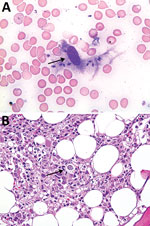 Thumbnail of Bone marrow smear sample (A) and bone marrow aspirate (B) for patient 2 with visceral leishmaniasis caused by Leishmania infantum, Lebanon. Arrows show amastigotes within macrophages. Panel A, Wright Giemsa stain, original magnification x400; panel B, hematoxylin and eosin stain, original magnification x200.