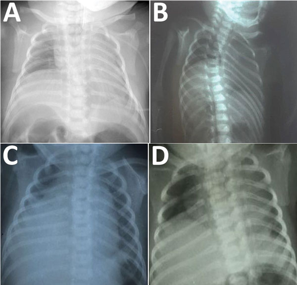 Chest radiographs of infants with congenital Zika syndrome, demonstrating elevation of the right hemidiaphragm. Panels A–D represent patients 1–4, respectively. In each instance, only the right hemidiaphragm was noticeably elevated. All patients also had arthrogryposis (including talipes equinovarus) and died from complications related to progressive respiratory failure.
