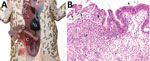 Thumbnail of Invasive colonic entamoebiasis in wild cane toads (Rhinella marina), tropical Australia, 2014–2015. A) Toad with severe colonic amebiasis. The colon (C) has been opened to show intraluminal hemorrhagic content and blood clots. There is segmental full-thickness necrosis of the colon wall (white arrow). Lung (L), small intestine (S), and gall bladder (G) are annotated for perspective. B) Photomicrograph of colonic amebiasis. The affected segment of mucosal epithelium, which contains s