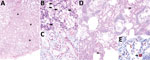 Thumbnail of Cetacean morbillivirus–associated histopathologic findings in 2 Guiana dolphins (Sotalia guianensis), a female adult (case 1, panels A–C) and a male calf (case 2, panels D–E) A) The mammary gland parenchyma is focally disrupted by lymphohistiocytic inflammatory cells (not visible at this magnification) associated with collapsed and lost acini, and mild fibrosis (asterisks). Original magnification ×40; hematoxylin and eosin (H&amp;E) stain. B) Swollen and degenerating mammary acinar 