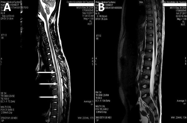 Magnetic resonance imaging (MRI) of the spine in a 10-year-old boy from Brazil with Angiostrongylus cantonensis infection. A) MRI before treatment showing myelitis; sagittal T1 postcontrast sequences show intramedullary enhancement in the thoracic spinal cord T2–T10 with diffuse leptomeningeal enhancement (arrows). B) Normal MRI 1 month after treatment.