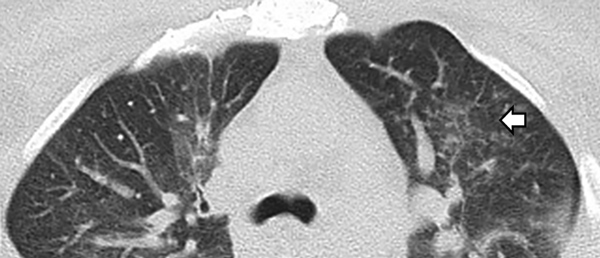 Computed tomography scan of the chest in a patient with Mycobacterium obuense pneumonia, Mexico, showing air space infiltration in the left parahilar and a tree bud pattern in the left upper lobe (arrow), as well as bilateral interstitial thickening and ground glass opacities.