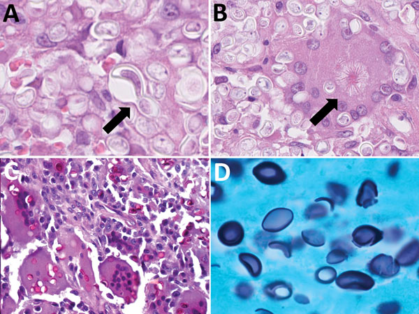 Pathologic findings from patients infected with African histoplasmosis, Democratic Republic of the Congo, July 2011–January 2014. A) Yeast explosive budding (arrow) (hematoxylin and eosin [HE] staining; original magnification ×160); B) asteroid bodies (arrow) (HE staining; original magnification ×160); C) yeasts in Langhans cells (periodic acid Schiff staining; original magnification ×160); D) lemon-shaped appearance (Grocott methenamine-silver staining; original magnification ×80).