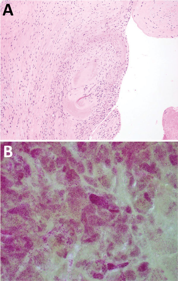 Results of testing for a 38-year-old man with Coxiella burnetii endocarditis and meningitis, California, USA, 2017. A) Cardiac valve tissue showing fibrous scar and chronic inflammation (hematoxylin and eosin stain, original magnification ×100). B) Numerous clusters of gram-negative cocci are consistent with intracellular organisms (Gram stain, original magnification ×1,000).