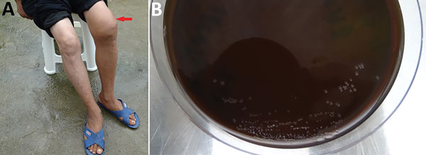 Patient from whom Paenibacillus assamensis was isolated from knee joint fluid, China, 2016. A) Left knee joint of the patient was obviously swollen (red arrow). B) P. assamensis isolated from the patient’s articular fluid appeared on chocolatized erythrocytes. 