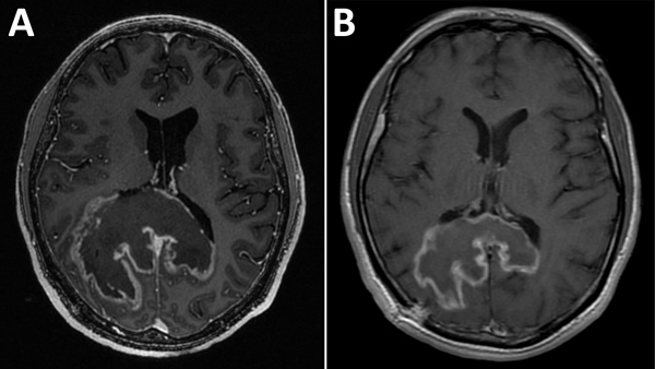 Images obtained during diagnosis of chagasic encephalitis in 31-year-old man in the United States. A) Contrast-enhanced T1-weighted magnetic resonance imaging of the brain showing a cerebral tumor-like chagoma in the axial plane. B) Follow-up contrast-enhanced T1-weighted magnetic resonance imaging obtained ≈8 weeks later showing improvement of the chagoma.