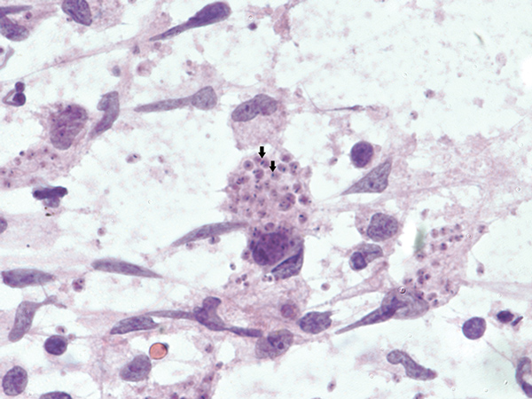Tissues obtained during diagnosis of chagasic encephalitis in 31-year-old man in the United States. Touch preparation of brain tissue showing necrotizing encephalitis and abundant Trypanosoma cruzi amastigotes with prominent kinetoplasts (arrows) in astrocytes and macrophages (hematoxylin and eosin stain, original magnification ×600).