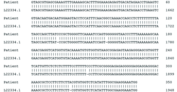 Sequences obtained during diagnosis of chagasic encephalitis in 31-year-old man in the United States. Alignment of amplicon sequence isolated from the patient was compared with a reference Trypanosoma cruzi 5.8S rRNA internal transcribed spacer sequence (GenBank accession no. L22334.1). Percentage identity was 98.9% (346/350 bases). Hyphens indicate gaps in the genome.