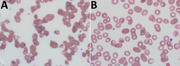 Peripheral blood films for a 60-year-old woman with probable locally acquired Babesia divergens–like infection, Michigan, USA. A) Before erythrocyte exchange transfusion. Parasitemia was 25%–30%. B) After erythrocyte exchange transfusion. Parasitemia was 3.5%. Original magnification ×1,000.