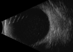 Thumbnail of B-scan ultrasonography of the left eye of a 63-year-old woman with Gordonia bronchialis–associated endophthalmitis, Oregon, USA, showing dense opacities in the vitreous space.