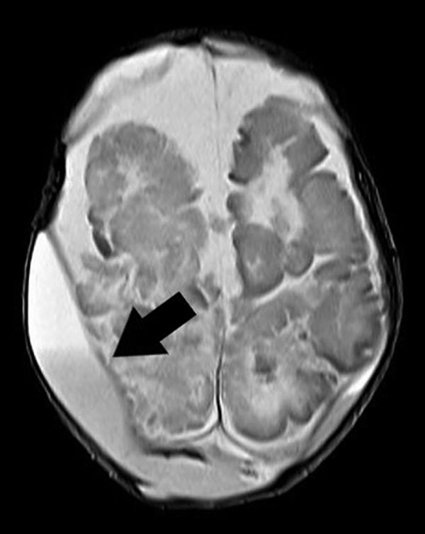Brain nuclear magnetic resonance image of a newborn with Cronobacter sakazakii sequence type 494 meningitis, Brazil. Extradural collections are visible in both parietal regions. Arrow indicates the more pronounced extradural collection, measuring ≈1.8 cm, in the right parietal region.