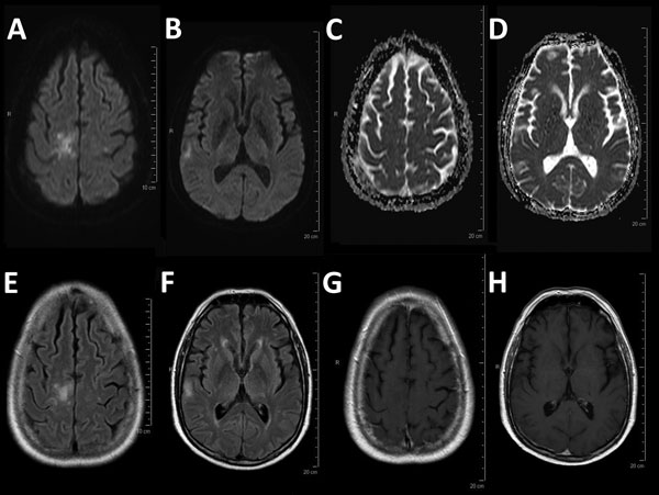 Magnetic resonance imaging for a 54-year-old man with progressive multifocal leukoencephalopathy after treatment with nivolumab, showing typical multifocal lesions: diffusion weighted imaging hyperintensity (A, B) without a decrease in the apparent diffusion coefficient (C, D), corresponding patchy corticosubcortical hyperintensities on fluid-attenuated inversion recovery image (E, F) without enhancement on T1-weighted imaging after administration of gadolinium (G, H).