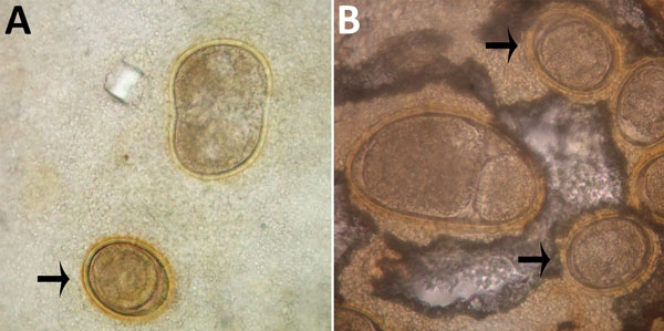 Abnormalities of Ascaris lumbricoides eggs from patients in the Solomon Islands, visualized on Kato-Katz. A) Giant egg with irregular indented shape. B) Giant egg with 2 morulae. Arrows indicate eggs of normal morphology. Original magnification ×400.