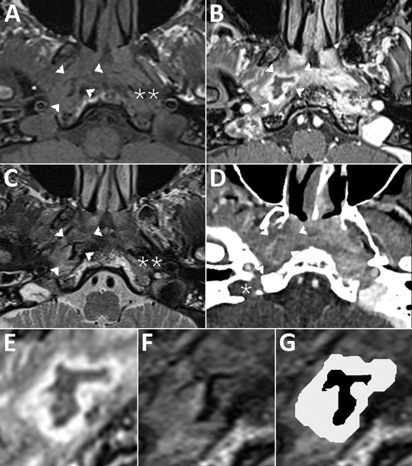 Magnetic resonance imaging (MRI) of a patient with malignant otitis externa, France. Cross-sectional imaging demonstrates a central skull base osteomyelitis in patient’s temporal bone. A) T1-weighted imaging; B, E) 3-dimensional T1-weighted imaging with gadolinium enhancement and fat saturation; C, F, G) T2-weighted imaging; and CT with iodine enhancement (D). Single asterisks (*) indicate jugular bulb thrombosis (panels B, D); double asterisks (**) indicate deep-spaces cellulitis (panels A–C). 