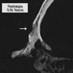 Thumbnail of Computed tomography scan of frontal bone with an osteolytic lesion with sclerotic walls (circumvallate cavitations). (Archive of the Division of Paleopathology. University of Pisa.) 