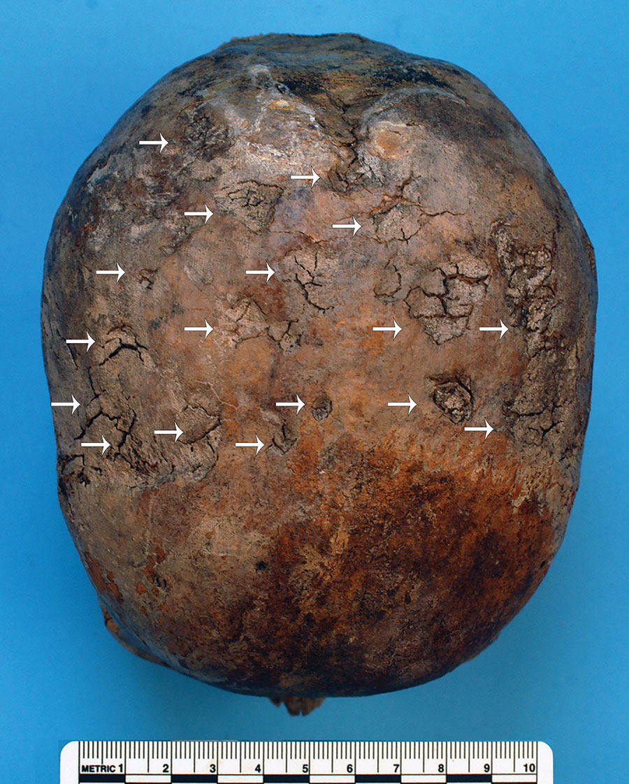 Parietal bones of Maria Salviati, showing several radial scars typical of tertiary syphilis. (Archive of the Division of Paleopathology. University of Pisa.) 
