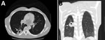 Thumbnail of Computed tomography images of the chest of an HIV-infected 47-year-old man (case-patient 3) with Cryptococcus gattii complex infection, southeastern United States. Transverse (A) and frontal (B) views without intravenous contrast showed a mass (arrows) (4.0 cm × 2.5 cm) that had central cavitation posteriorly in the right lower lobe abutting the pleural surface. The central cavitary portion of this lesion had a maximum length of ≈1.3 cm and no evidence of fluid level or internal sof