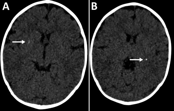 Cerebral computed tomography images of infant with probable congenital Zika virus infection at 7 months of age, Brazil. A) Mild calcifications at the right lenticular nucleus (arrow); B) calcifications at the posterior arm of the left internal capsule (arrow).