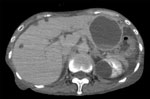 Thumbnail of Enhanced computed tomography image showing a large hepatic cyst (63 mm in diameter) on the left liver lobe in a patient with Helicobacter cinaedi infection on the day of hospital admission, Tokyo, Japan, July 2017.