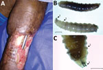 Thumbnail of Pin-site myiasis in a 77-year-old man 12 years after tibial osteosynthesis, Colombia. A) Open wound in the man’s left leg, showing multiple insect larvae. B, C) Cochliomyia hominivorax screwworm fly larvae extracted from the wound. Arrow 1 indicates the spinose bands; note the spines arranged in 4 rows that separate each segment. Arrow 2 indicates its mouthhooks. Scale bars indicate 2 mm (B) and 1 mm (C).